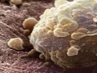 Biorezonans İle Kanser Tedavisi